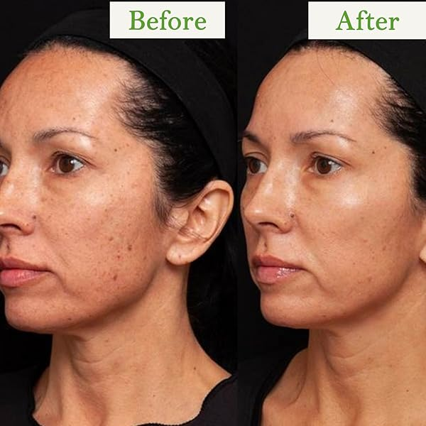Green Tea Facewash | Fighting Acne & Balancing Oil Production My Store